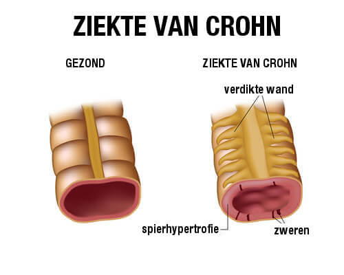 De ziekte van Crohn behandelen met het juiste dieet - BESCHERMT UW